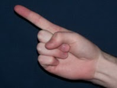 SEXUALITY: Δείκτης χεριού και καρκίνος του προστάτη